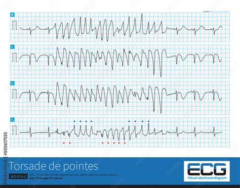 Male 75 Years Old Clinically Diagnosed As Acute Anterior Septal