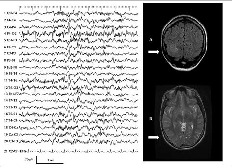 JLE Epileptic Disorders Fixation Off Sensitivity In Epilepsies