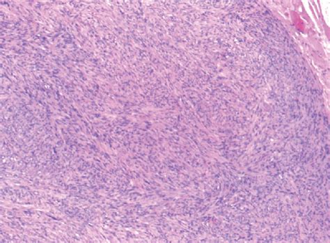 Histological Findings Of The Case Of Angioleiomyoma Reported A B C