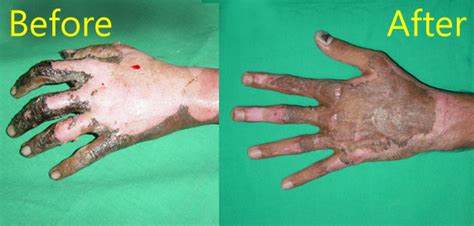 Burns And Burn Deformities Trichy Plastic Surgery The Official