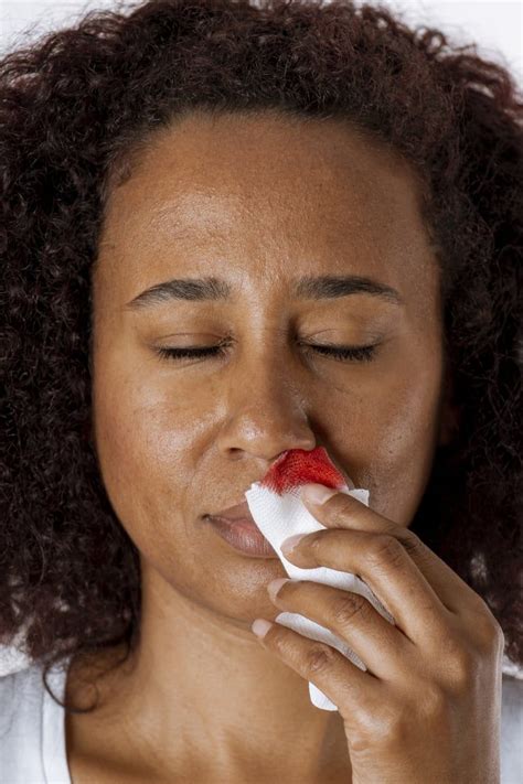 Ive Had Severe Nosebleeds For Over 20 Years — Here Are 4 Ways I Put A