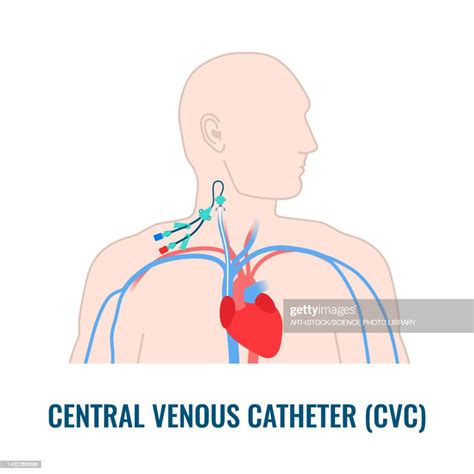 Central Venous Catheter Illustration High Res Vector Graphic Getty Images