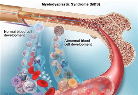 Myelodysplastic Syndromes: Types, Symptoms & Treatments