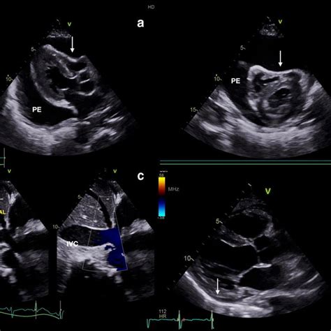 52 Year Old Woman With Calcific Constrictive Pericarditis A Tissue Download Scientific Diagram