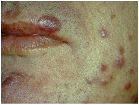 Hiv Lesions On Face