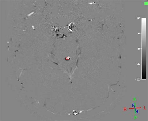 Normal Pressure Hydrocephalus Image