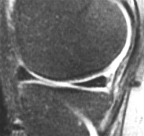 Mr Imaging Of Meniscal Contusion In The Knee Ajr