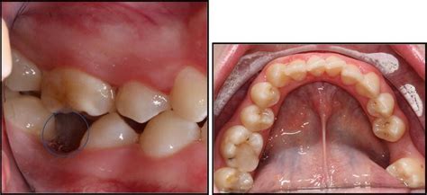 Molar Incisor Hypomineralisation Mih Training Manual For Clinical