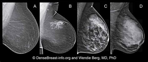 Dense Breasts Answers To Commonly Asked Questions National Cancer