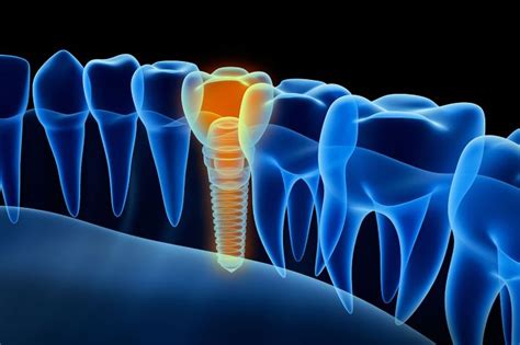 Why Replacing Lost Teeth Is Important The Implant Difference Sanford