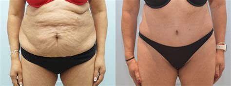 Tummy Tuck Before And After