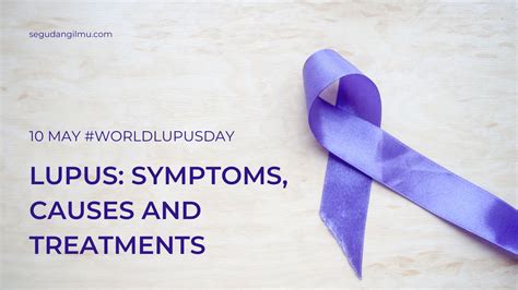 Lupus Symptoms Causes And Treatment Pendidikan Masa Depan