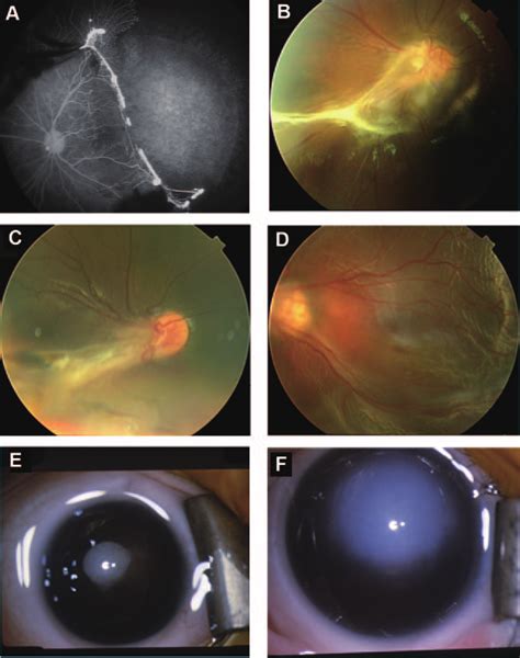 Fundus Photographs And Fluorescein Angiograms Of Patients A