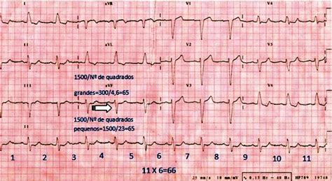 Blog De Eletrocardiografia Conceitos B Sicos C Lculo Da Frequ Ncia