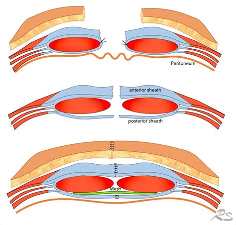 Optimal Abdominal Wall Reconstruction Surgery By Dr Saurabh Kalia