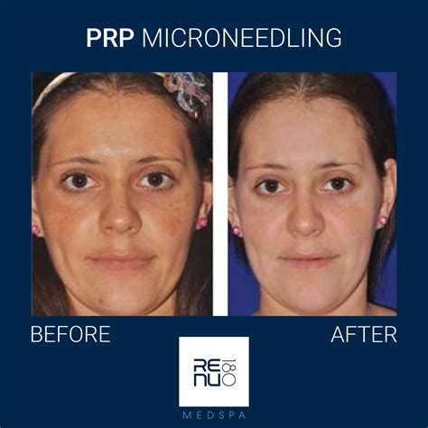 Before And After Gallery Prp Microneedling Re Nu Medspa