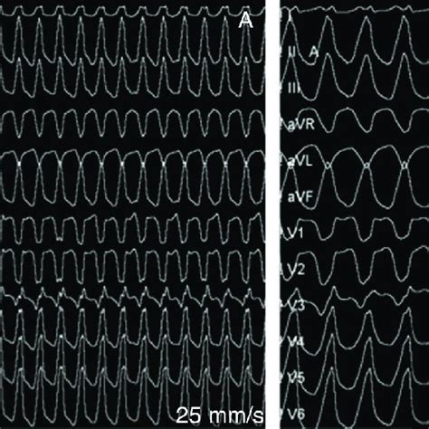 Electrophysiological Study A Induction Of Ventricular Tachycardia