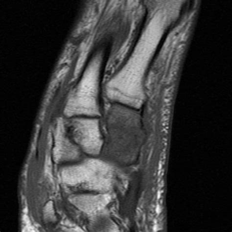 Medial Cuneiform Fracture Mri Image