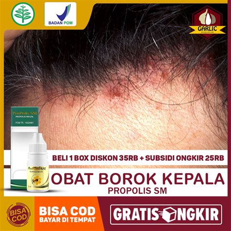 Jual Obat Borok Bisul Koreng Bernanah Ketombe Di Kepala Penghilang