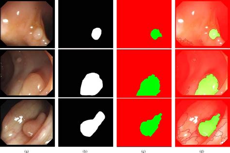 [pdf] Towards Automatic Polyp Detection With A Polyp Appearance Model