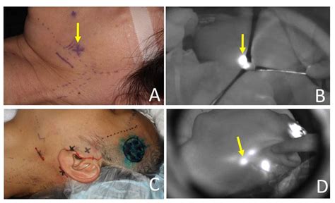 Why Remove Lymph Nodes