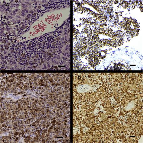 Histologic features supporting the diagnosis of malignant melanoma. (a ...