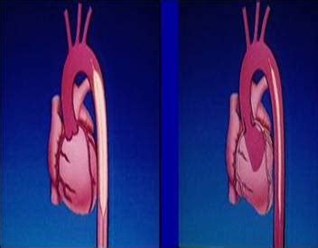 Medical Instrumentation: Intra Aortic Balloon Pump and Cardiac Angiogram