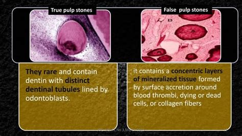 Pulp stone | PPT