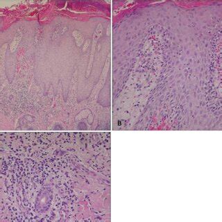 A Histologic Examination Shows Hyperkeratosis Pseudoepitheliomatous