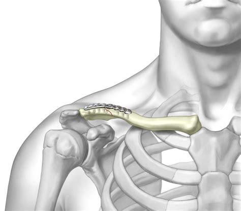 Superior Lateral Clavicle Plate Upper Extremity Fixation Trimed Inc