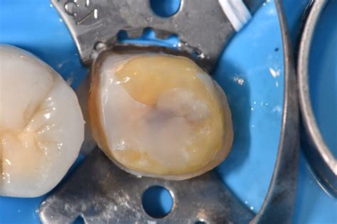 Preserving Tooth Structure in a Crown Preparation Design