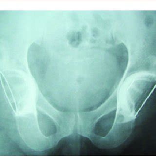 Anteroposterior Radiography Of The Pelvis Showing Bilateral