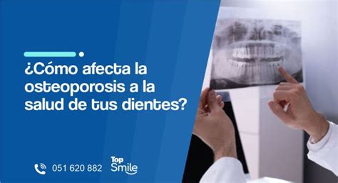 ¿cómo Afecta La Osteoporosis A La Salud De Tus Dientes