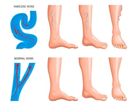 Conjunto Realista De Anatomía De Venas Varicosas Con Esquema De Aumento