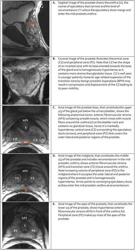 Pi Rads Prostate Imaging Reporting And Data System 2015 Version 2