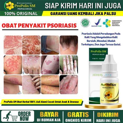 Jual Obat Gatal Psoriasis Selangkangan Salep Borok Di Selangkangan