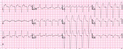 Dr Smith S Ecg Blog Paced Rhythm Is There Ischemic St Elevation