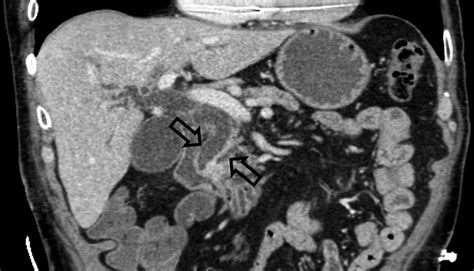 Ct View Showing Dilatation Of Both The Bile And Pancreatic Ducts Download Scientific Diagram