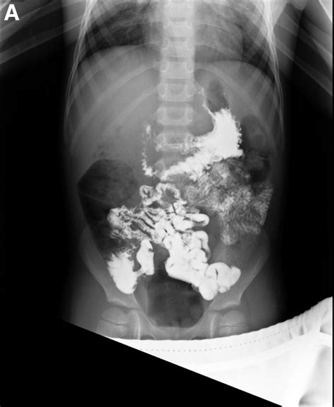 Meckels Diverticulum On Small Bowel Follow Through Series And