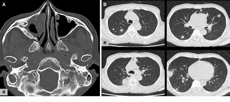 Figure 2 From Granulomatosis With Polyangiitis Presenting With