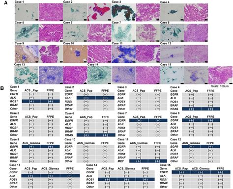 Cancer Cytopathology On Twitter New Archived Cytological Specimens