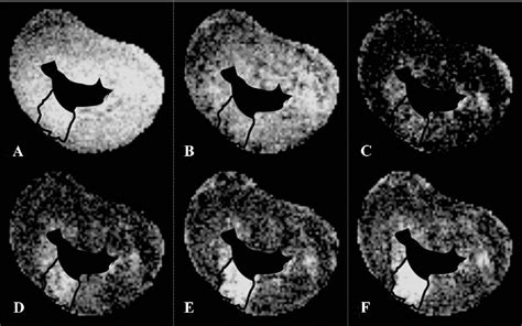 Figure 3 From Identification Of Chronic Myocardial Infarction With