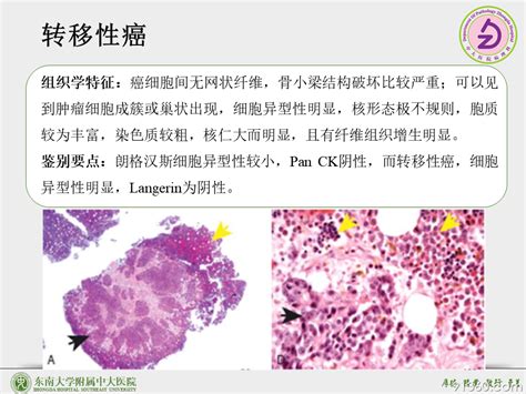 Langerhans细胞组织细胞增生症 病例分享【东南大学附属中大医院】 东南大学附属中大医院病例分享 91360病理论坛