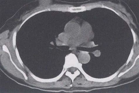 乳腺腺纤维瘤 内分泌 医学