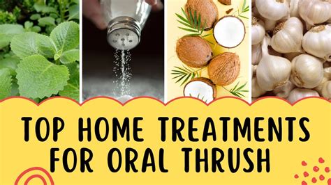 Top Home Treatments For Oral Thrush Yeast Infection Aka Candida Youtube