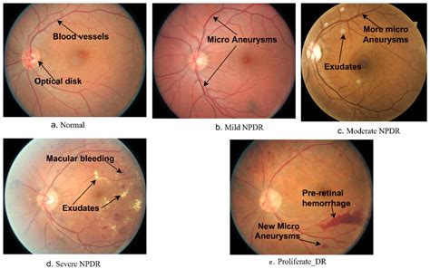 Diabetic Retinopathy Stages