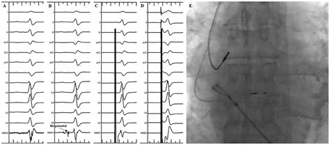 Frontiers Novel Wide Band Dielectric Imaging System Guided Lead Deployment For His Bundle