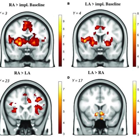 Brain Activation During The Decision Phase Intertemporal Choice Download Scientific Diagram