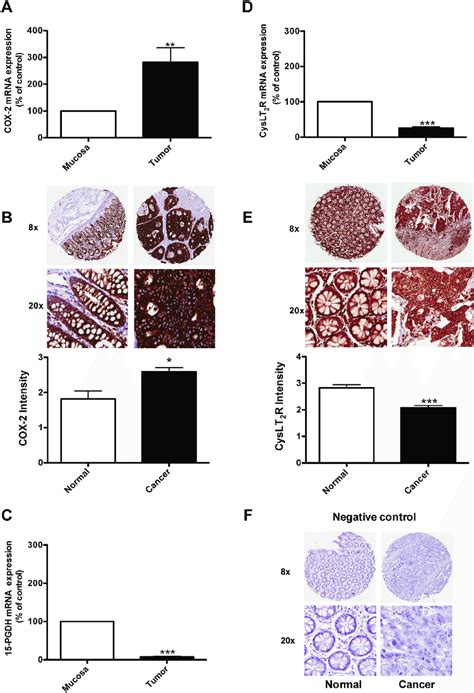 Expression Of Cox 2 15 Pgdh And The Cyslt 2 Receptor In Colon Cancer