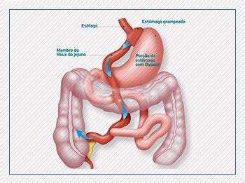 Cirurgia Bariátrica - Especialista em Cirurgia Robótica - Cirurgia de ...